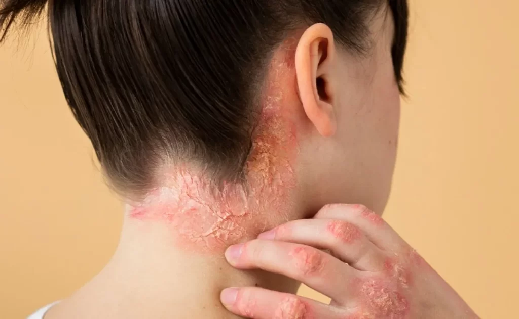 tina-resistente-a-medicamentos.jpg_172596871